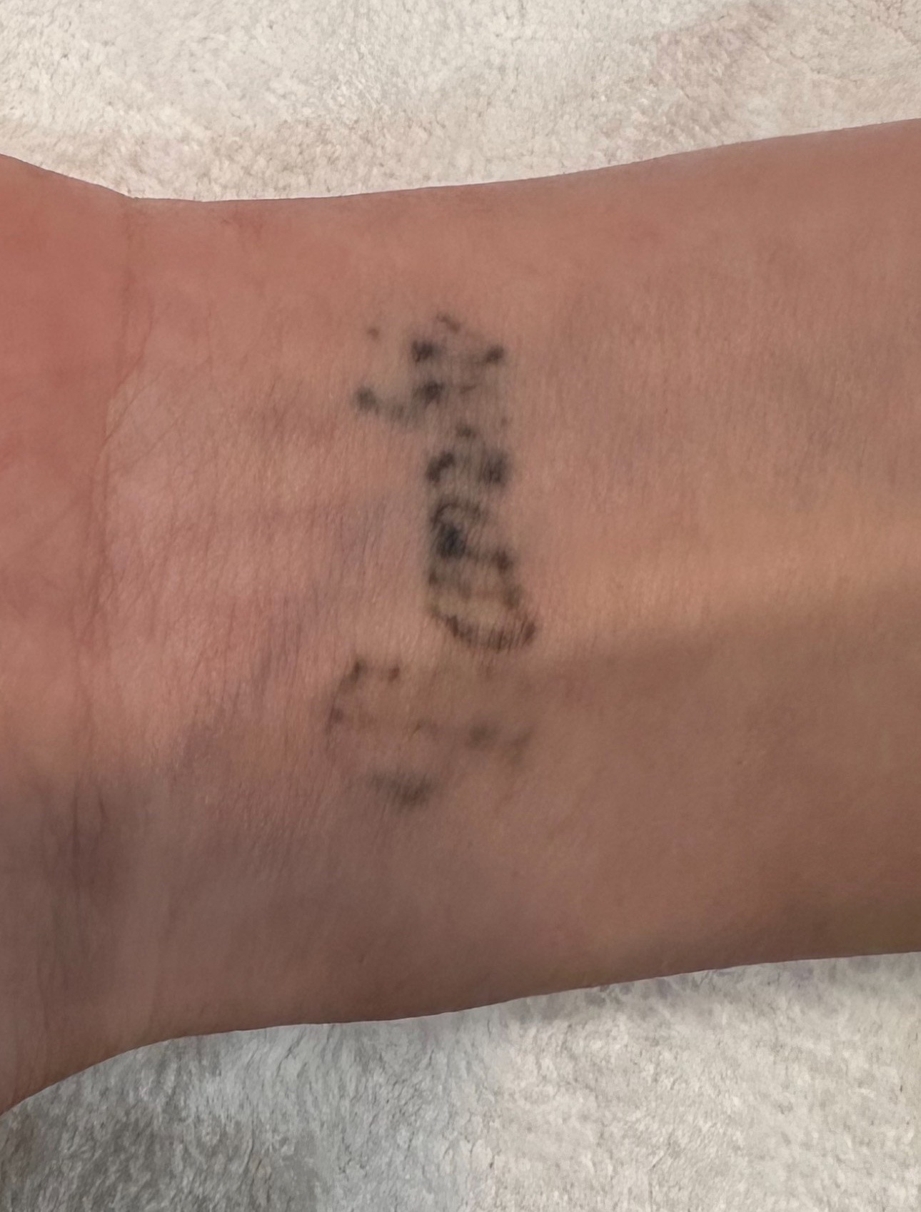 tattoo removal after