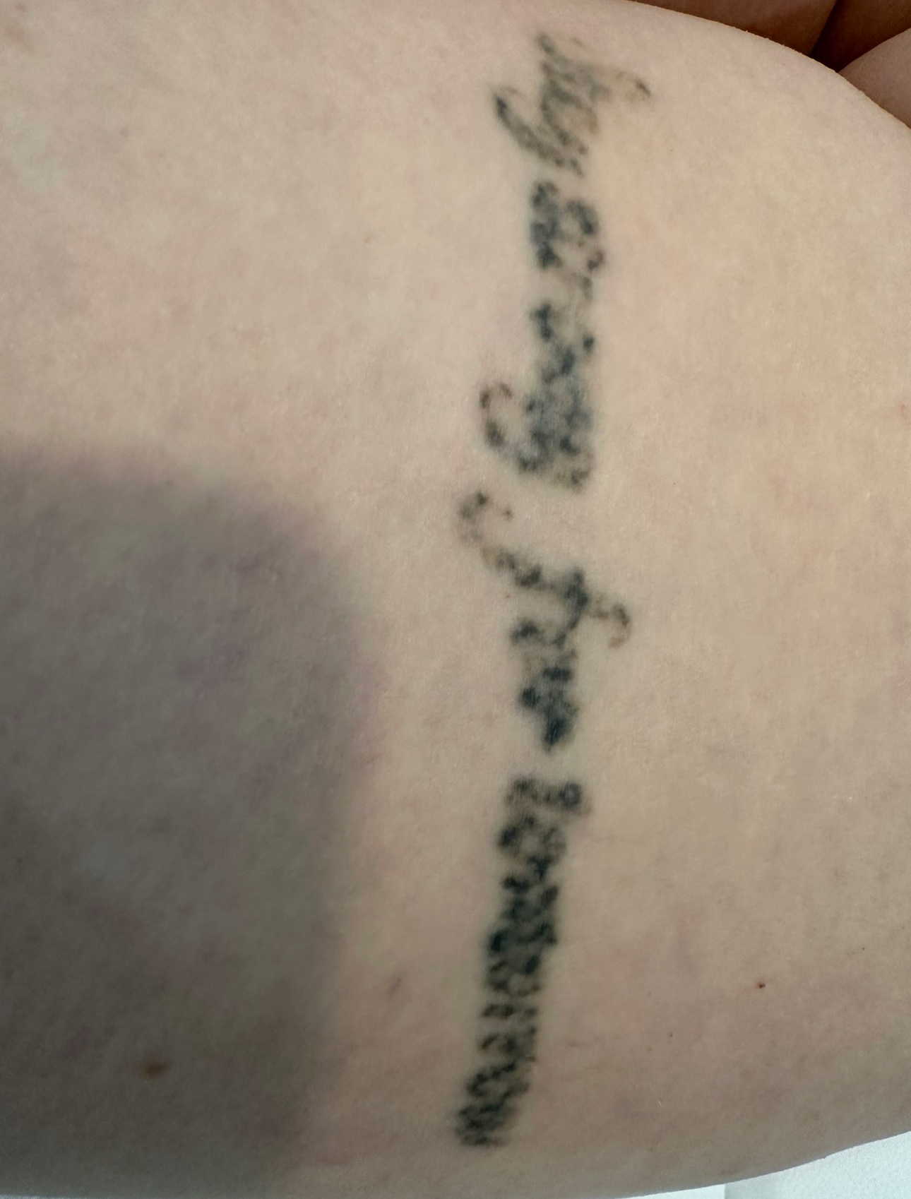 tattoo removal after